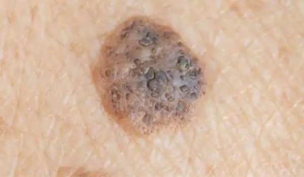 Seborrhoeic Keratosis: Benign vs Malignant Cannock