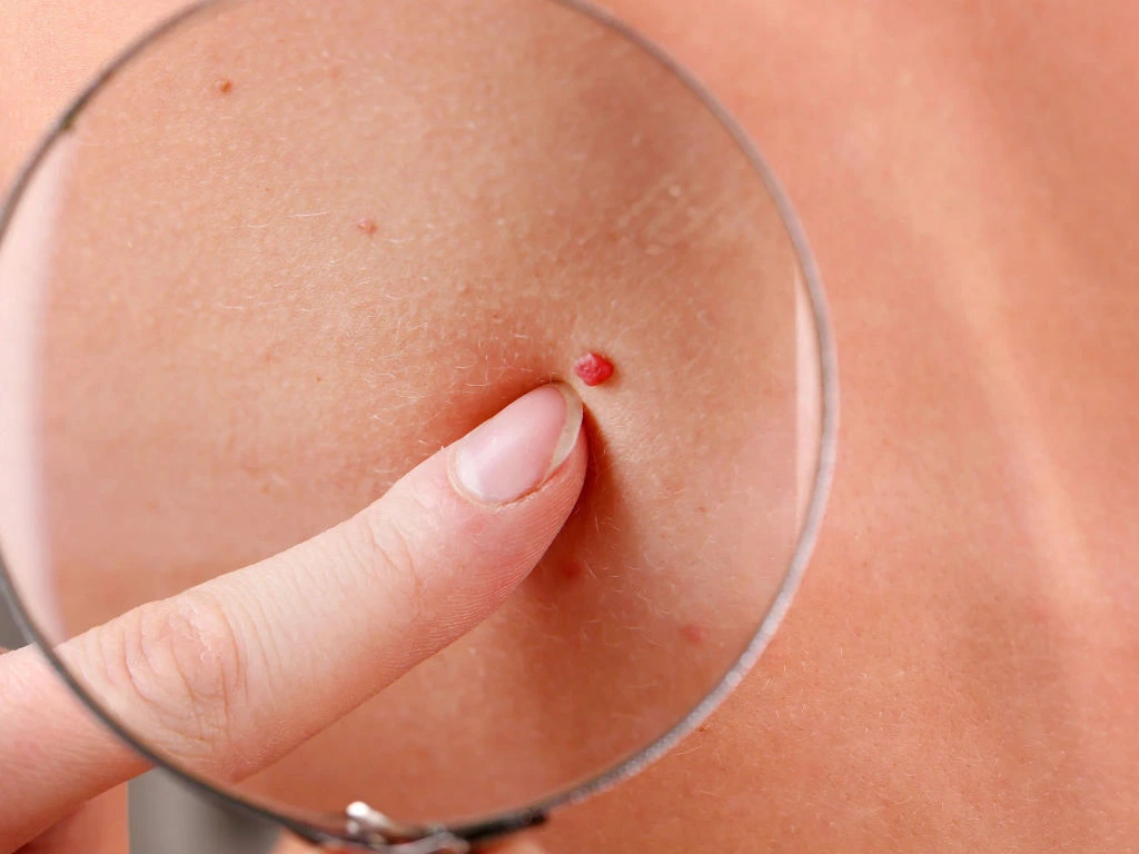 Cherry Angiomas on skin showing vascular structure and Cryosonic CryoPen treatment for effective lesion removal Cannock